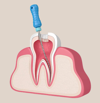 Root Canal Image 2